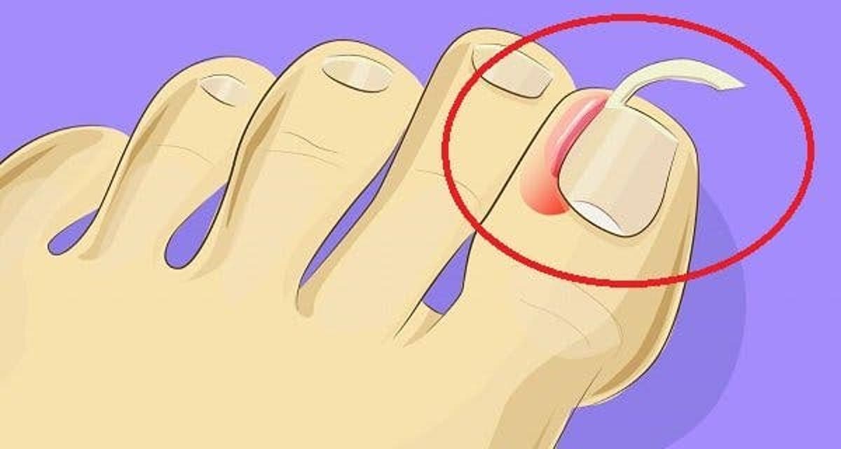 Ongle incarné au pied : que faire pour le soigner ? – Fogeg