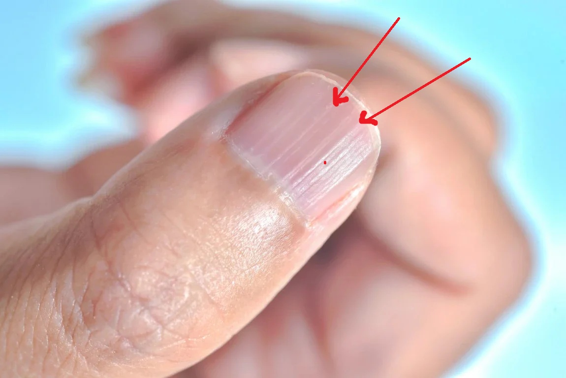 Ce que ces lignes verticales sur vos ongles révèlent réellement Fogeg — free download